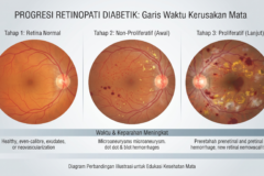 Retinopati Diabetik: Kenapa Penderita Diabetes Wajib Rutin Periksa Mata