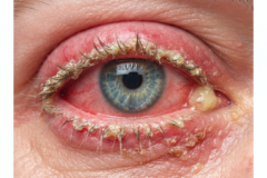 Konjungtivitis (Mata Merah/Belekan): Kapan Berbahaya dan Kapan Bisa Ditangani di Rumah?