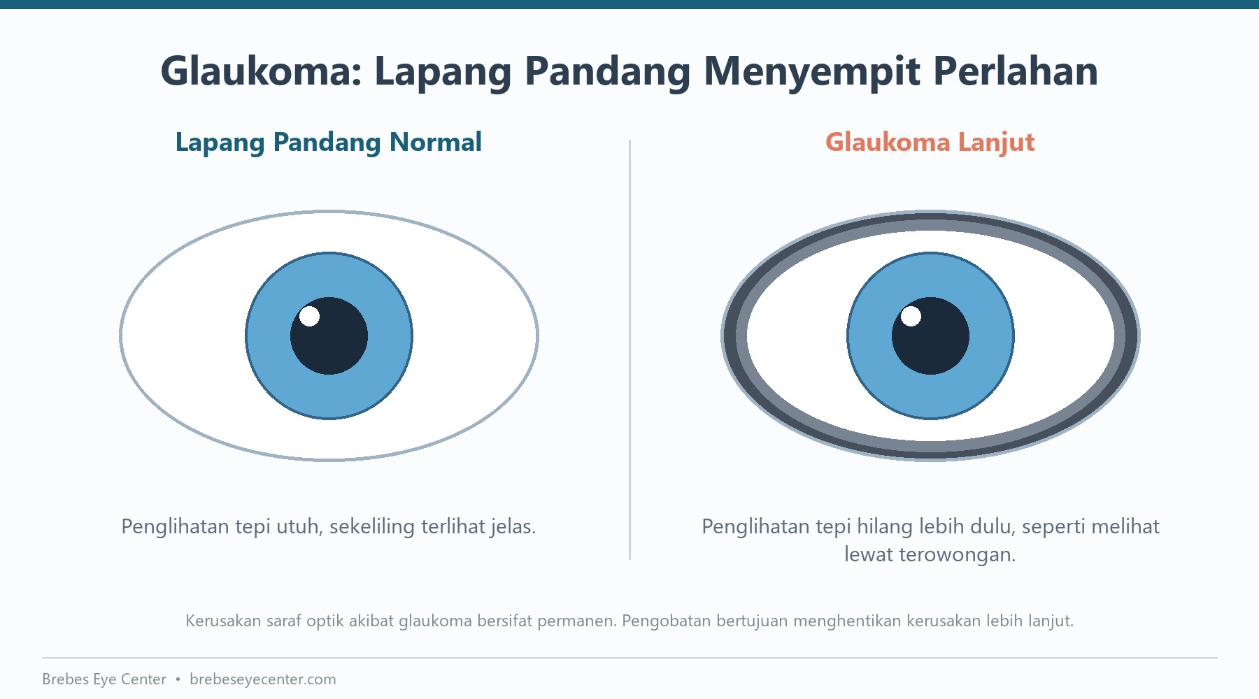 Glaukoma: Pencuri Penglihatan yang Datang Tanpa Suara Glaukoma: Pencuri Penglihatan yang Datang Tanpa Suara