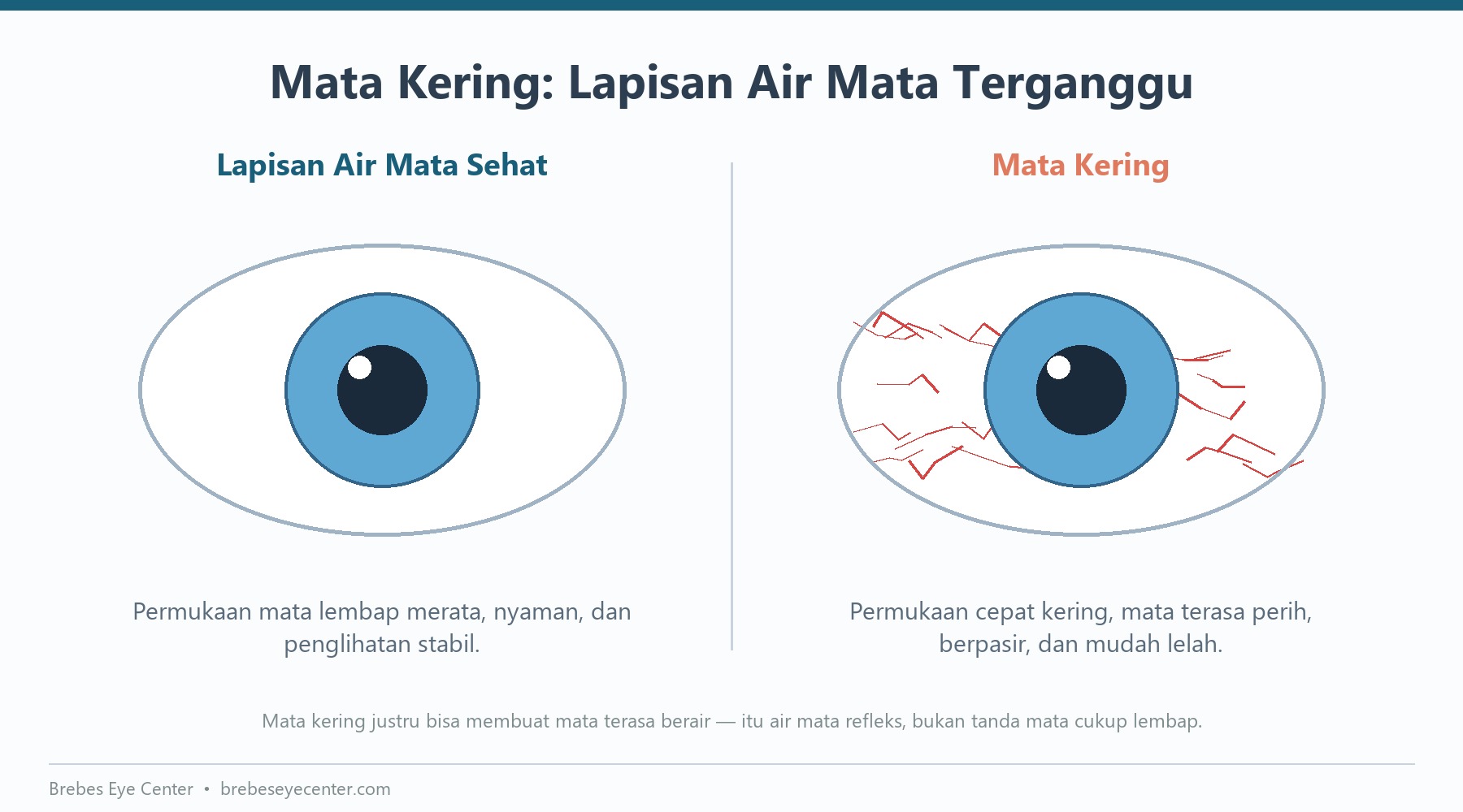 Mata Kering: Bukan Sekadar Mata Lelah Mata Kering: Bukan Sekadar Mata Lelah