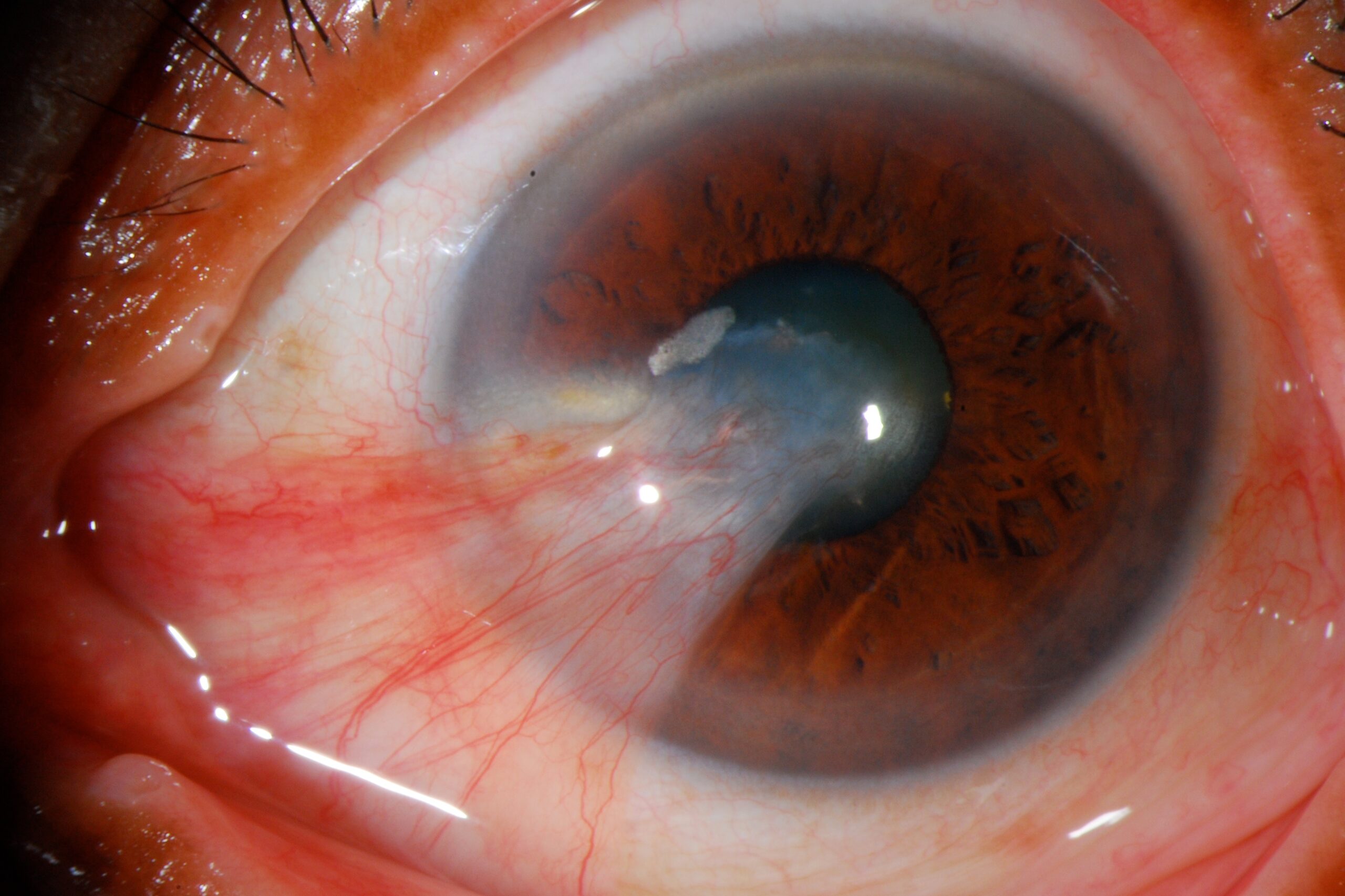 Pterigium (Selaput Mata): Kenali Penyebab, Gejala, dan Penanganannya